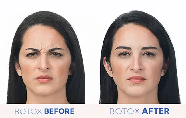 Botox Filler