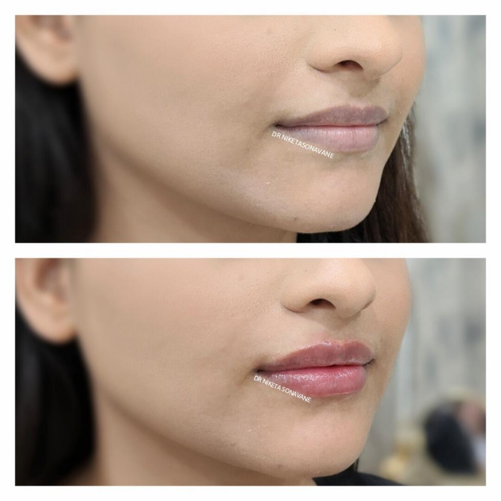 Permanent Lip Lightening