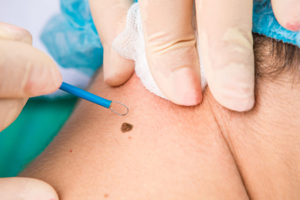 Mole & Warts Removal